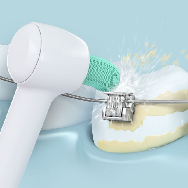 Giải pháp chăm sóc răng miệng mới cho bệnh nhân chỉnh nha